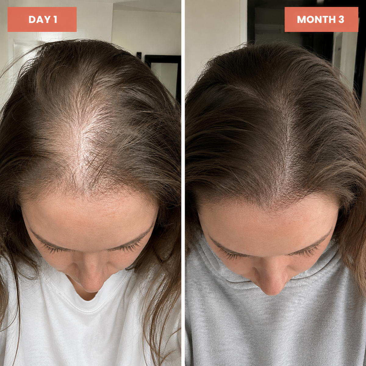 Illustrative 90-day hair density progress comparison